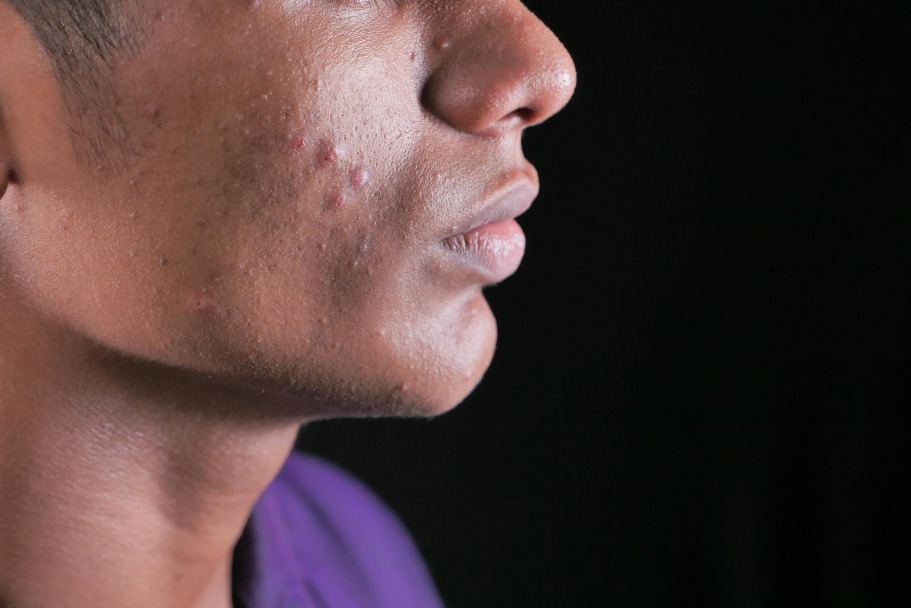 young woman with acne skin treatment